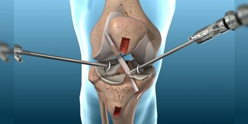 Best Arthroscopy Surgery in Noida